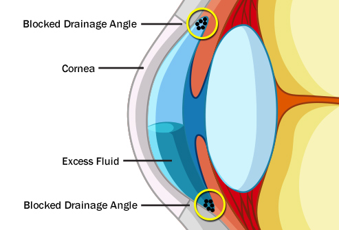 Eye conditions