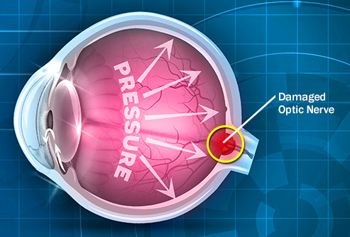 Eye conditions